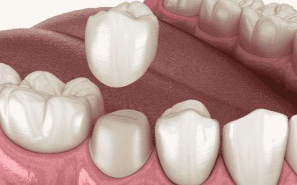 Dental Implants in Tirupur