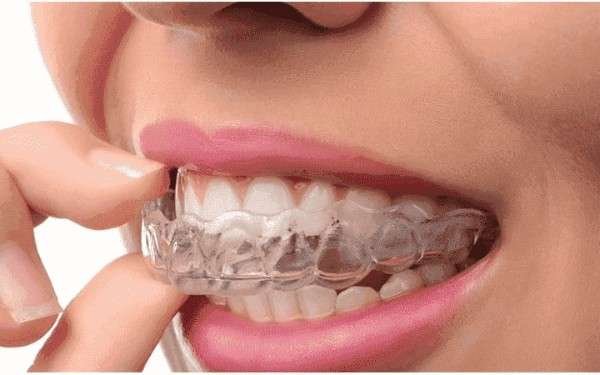Invisible braces treatment by best dentist in Tirupur