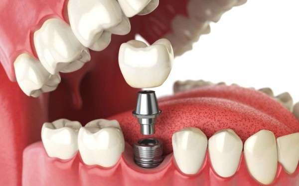 Dental Implants in Tirupur