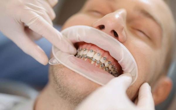 Dental Implants in Tirupur