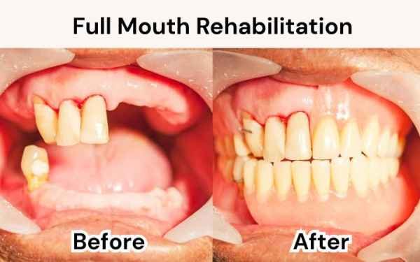 full mouth rehabilition