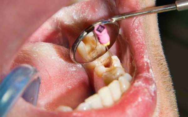 Root Canal Treatment in Tirupur