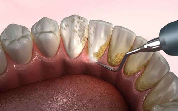 Dental Implants in Tirupur
