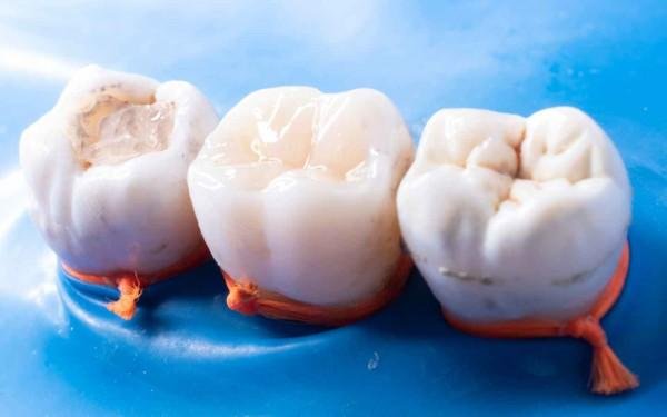 Dental Implants in Tirupur