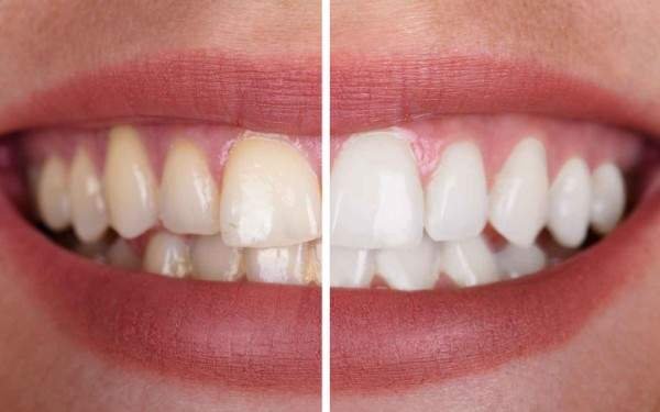 teeth whitening treatment in tirupur