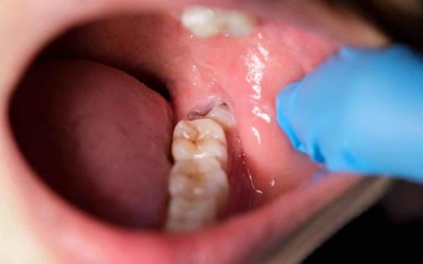 wisdom teeth removal in tirupur